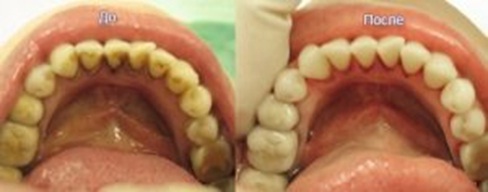 Зачем нужна профессиональная чистка зубов у стоматолога